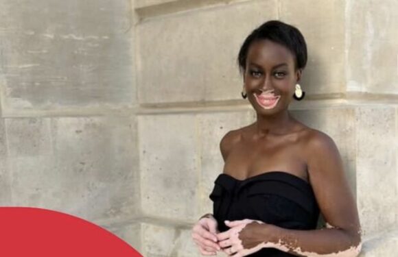 PHOTO – Miss France 2024 : qui est Estelle Mendy, cette candidate atteinte de vitiligo ?